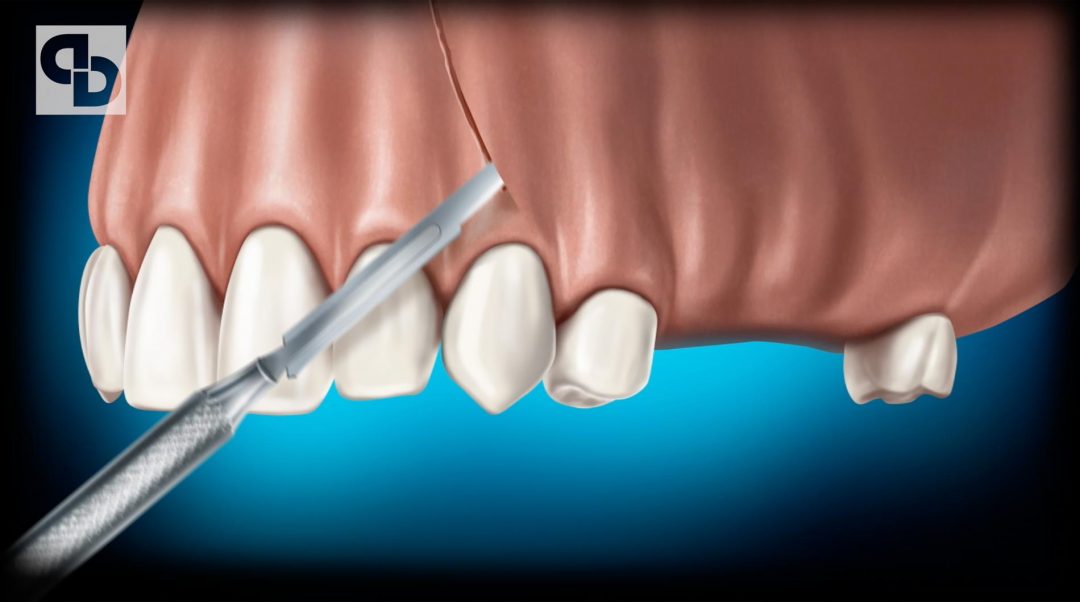 Técnica extracción quistes dentales. Denture cyst extraction technique ...